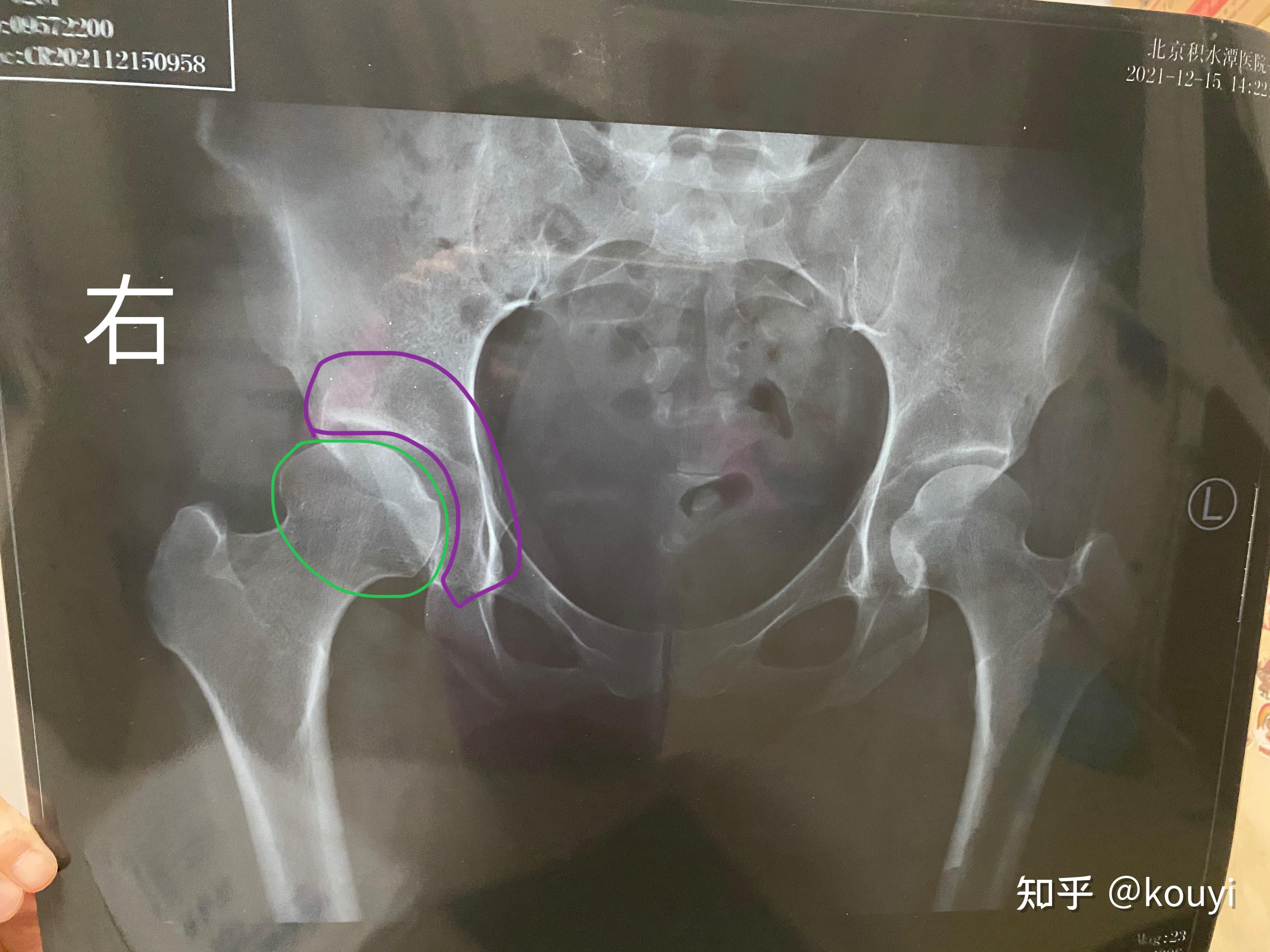 小儿髋关节x线图片