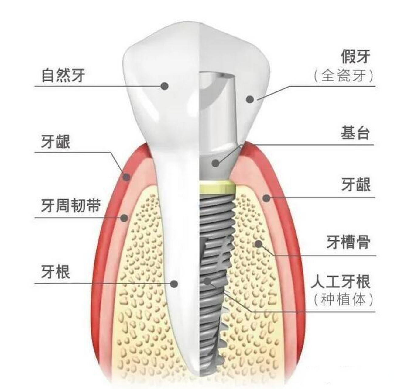种植牙种植牙是一种常见的牙齿缺失修复方式,它通过在缺失牙齿的位置