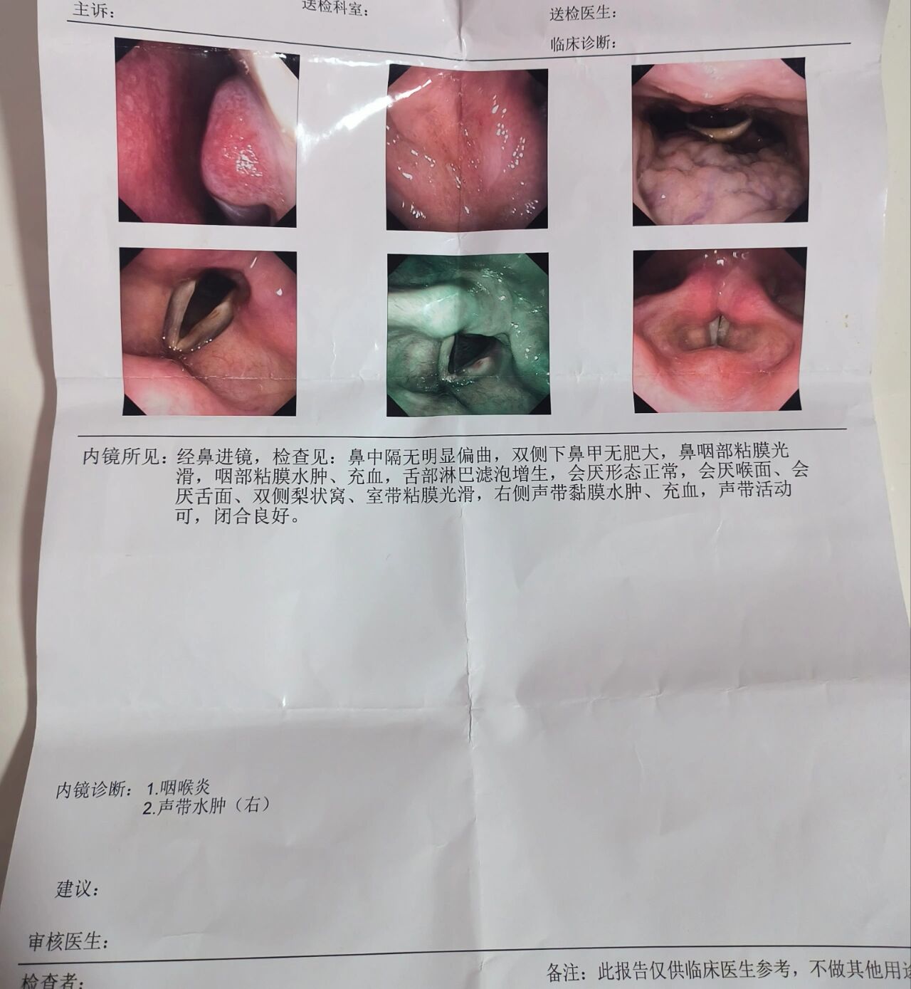 梨状窝位置图左右分别图片