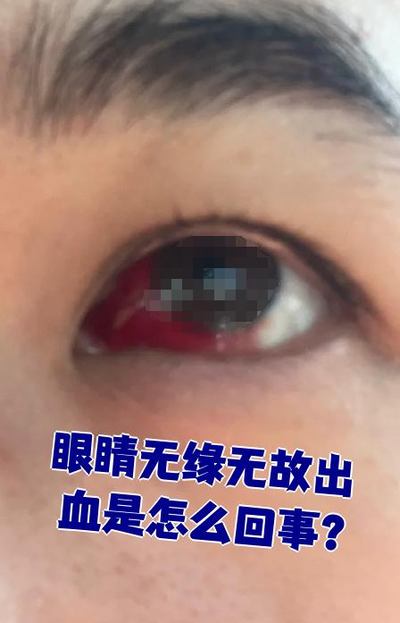 结膜下出血是因为眼睛表面的小血管破了,血渗出来积在结膜下面