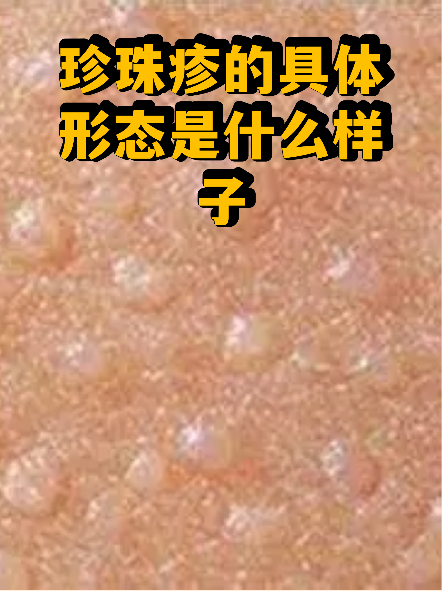 珍珠疹的具体形态是什么样子