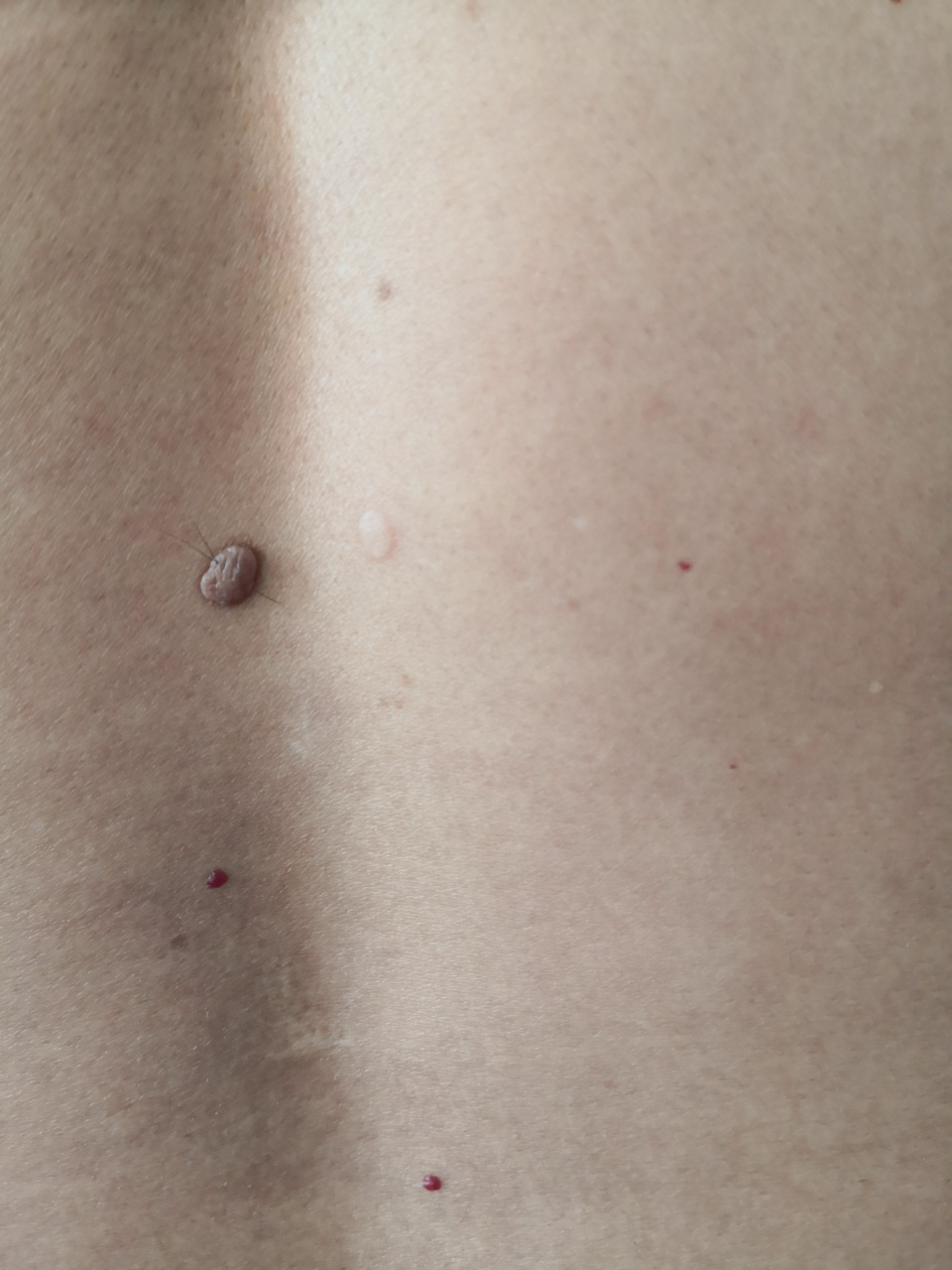 背部黑色素痣.手术切除活检诊断一下比较好#美容##色素痣