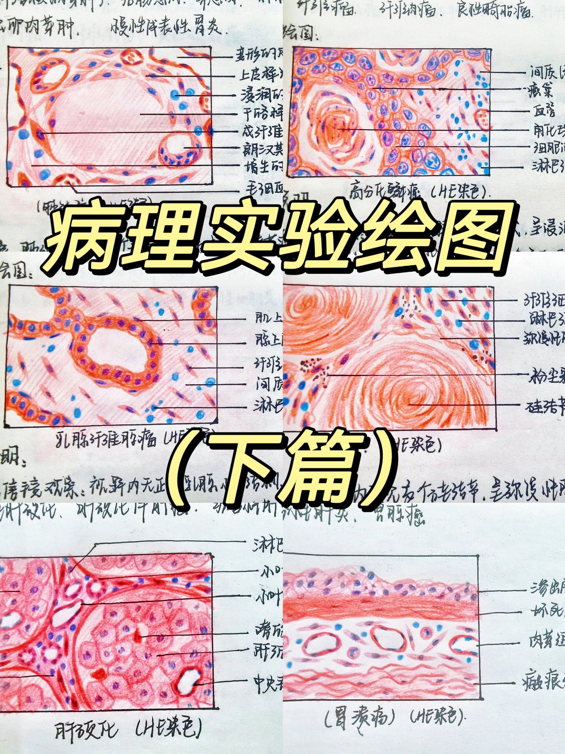 胃溃疡手绘图红蓝铅笔图片