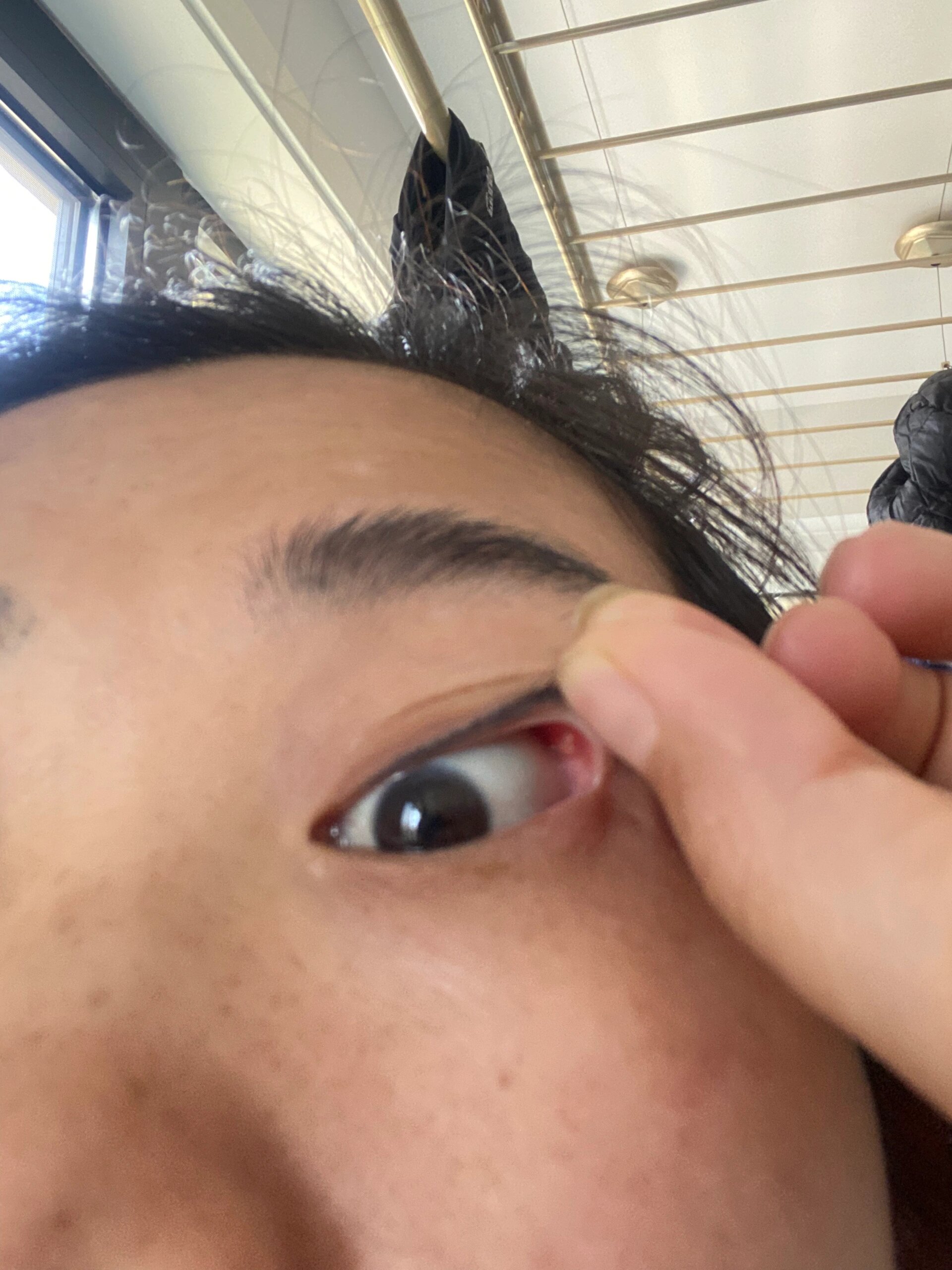 这是什么?上眼皮里长了个白色疙瘩