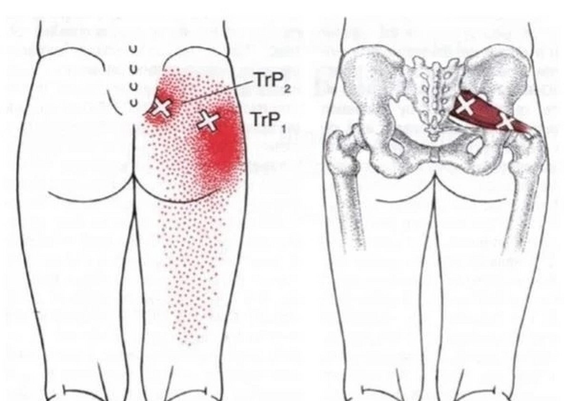 环跳穴: 治疗腰痛的一个神奇穴位 环跳穴,顾名思