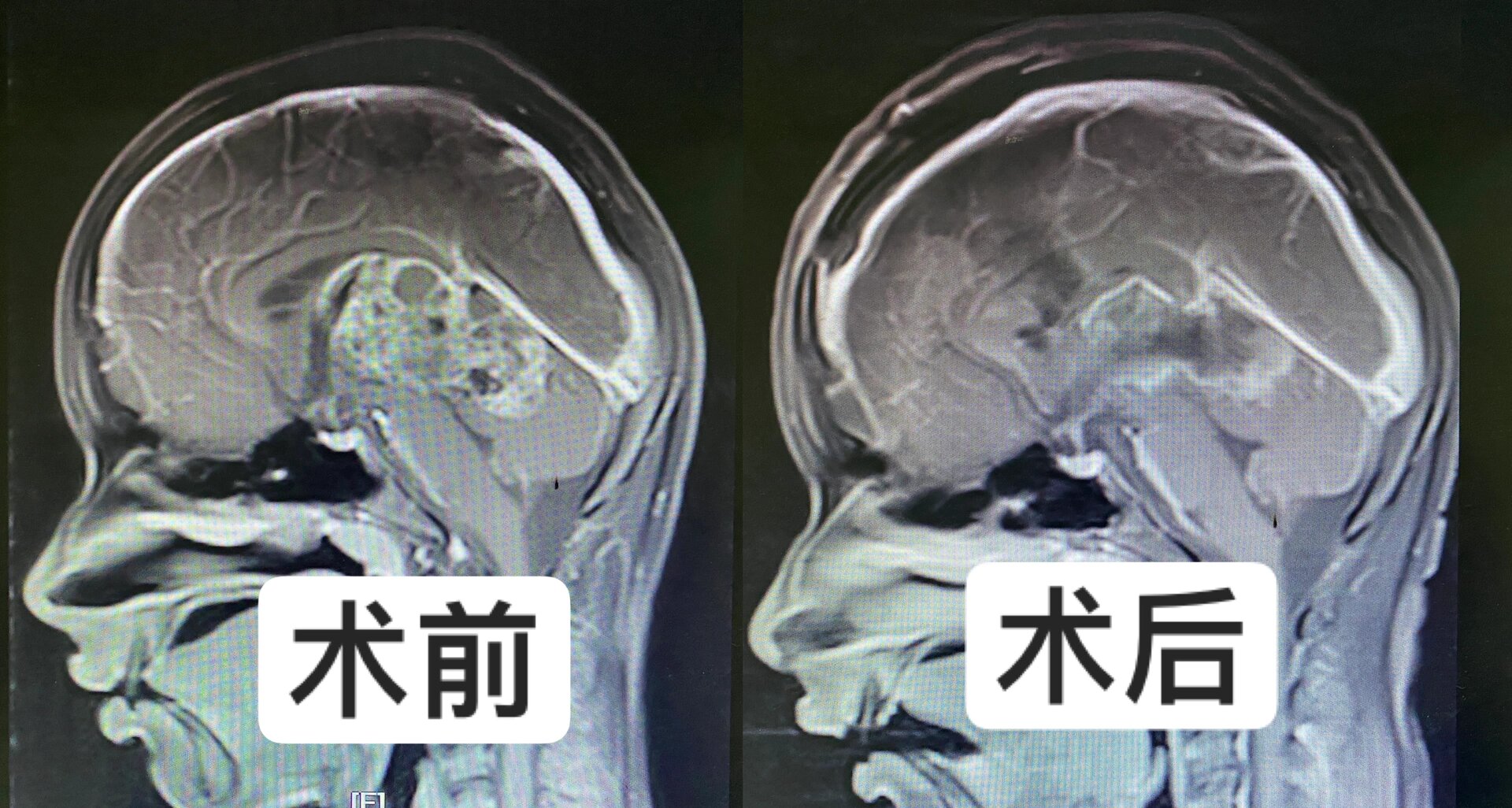 松果体肿瘤一般多大图片