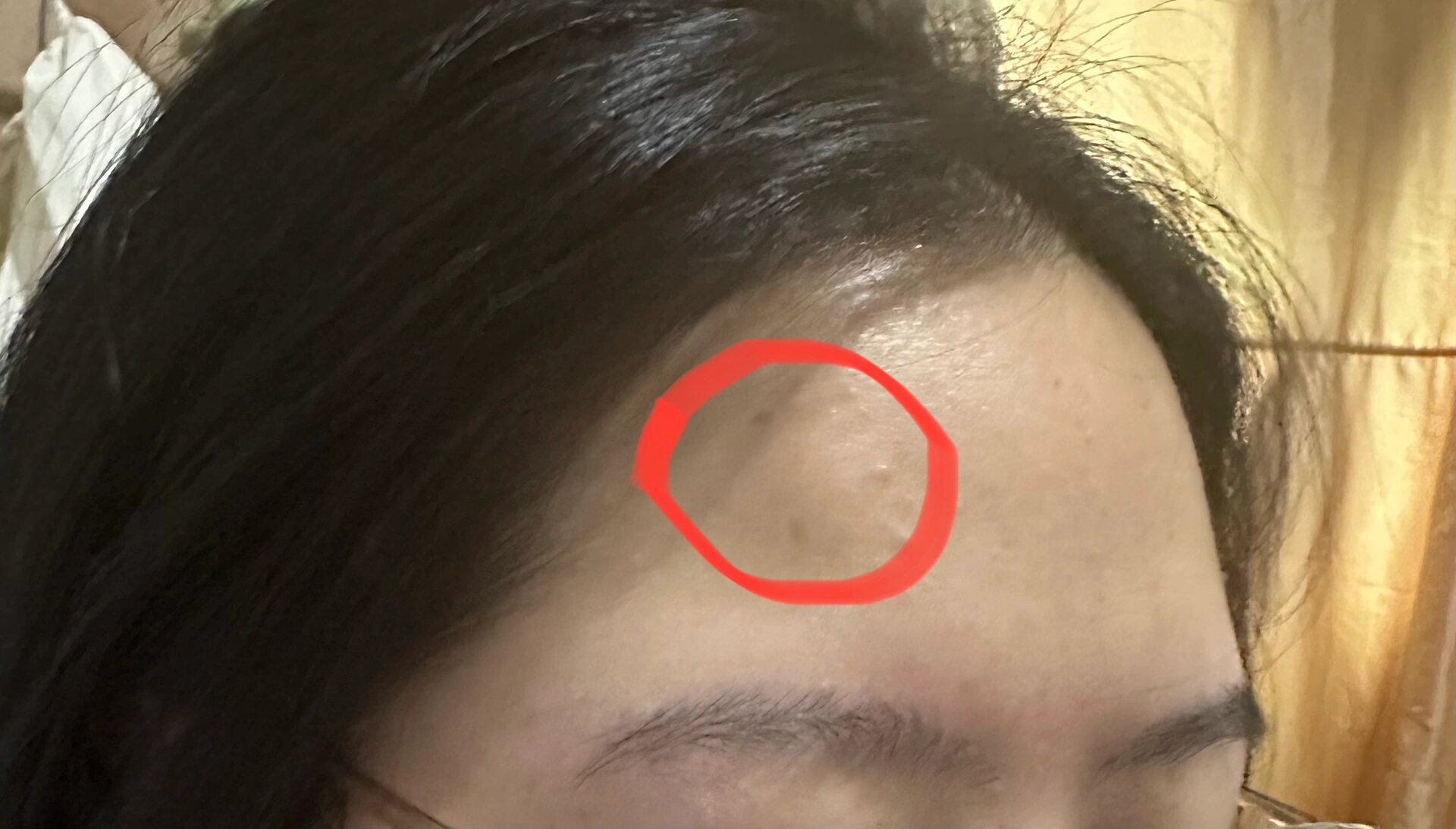 额头凸起一块,急急急05