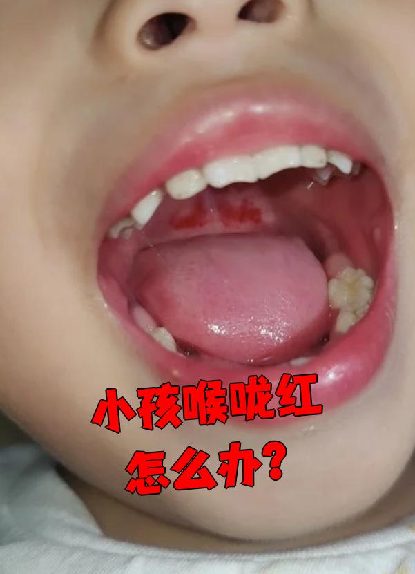 孩子喉咙发红怎么办?这要看具体原因