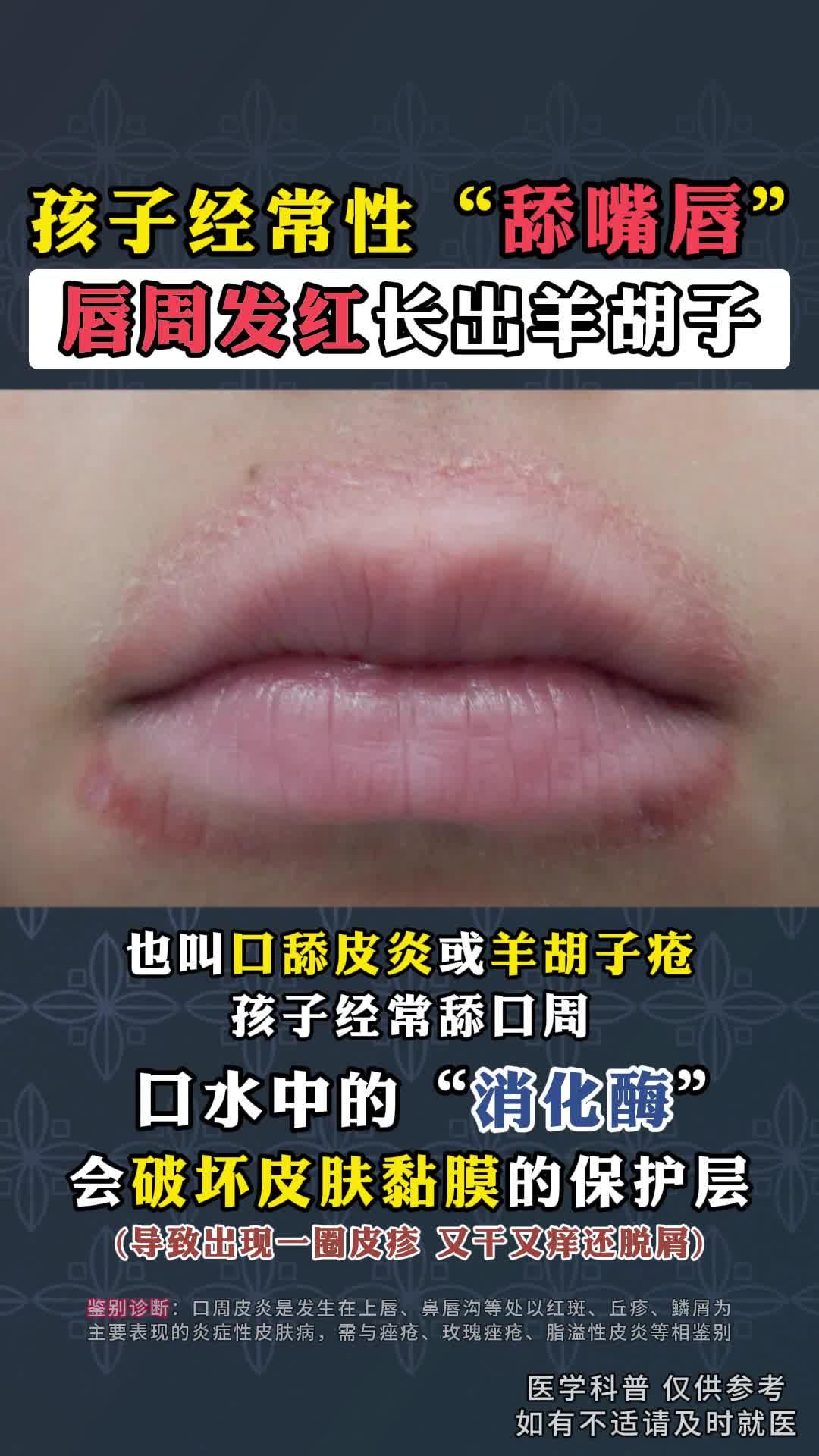 小孩子经常舔嘴唇嘴唇周围一圈红疹口周皮炎他克莫司软膏医学科普