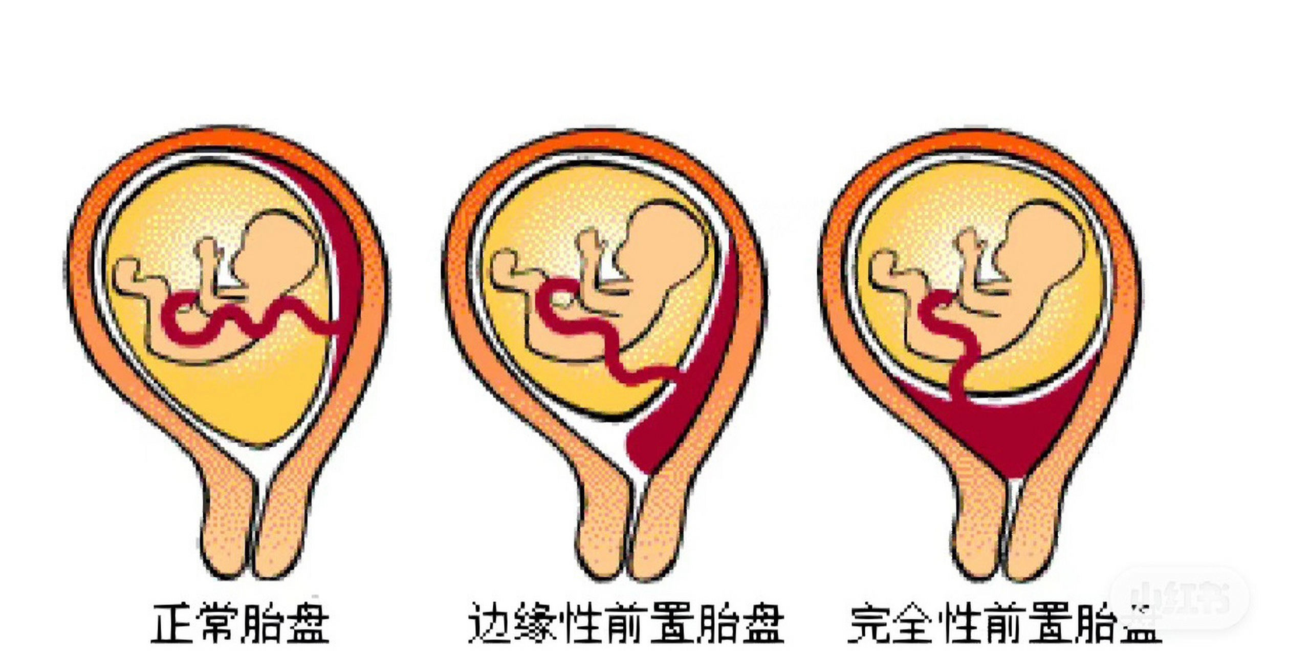 完全性前置胎盘图片图片