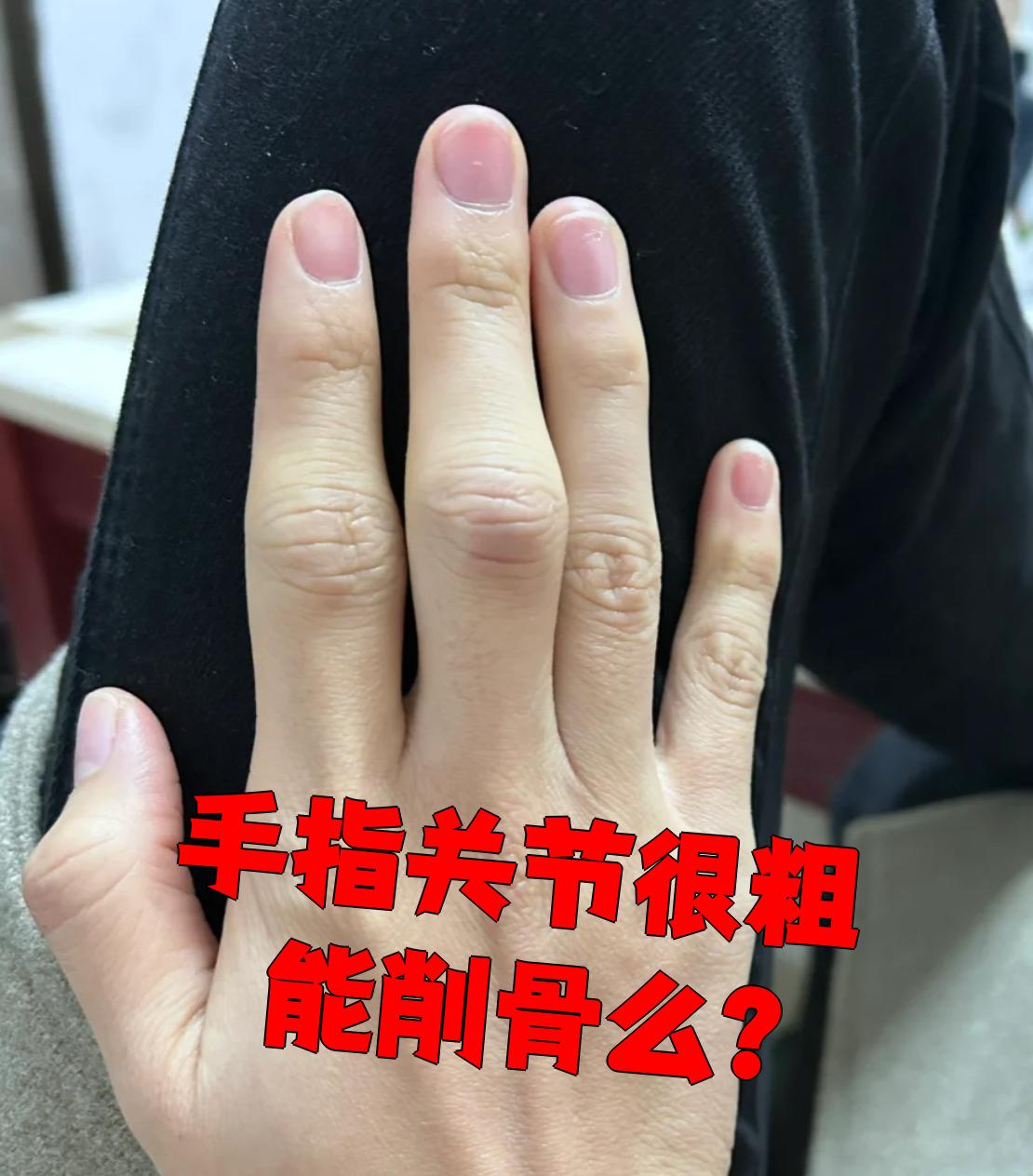 常见的原因有遗传,类风湿性关节炎,痛风结石,周围滑膜水肿等,每种情况