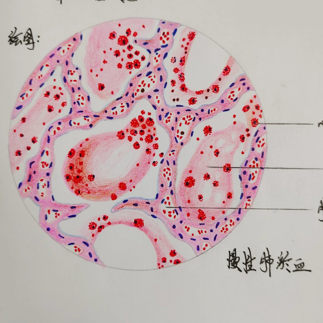慢性肺淤血 慢性肺淤血病理切片红蓝铅笔绘图