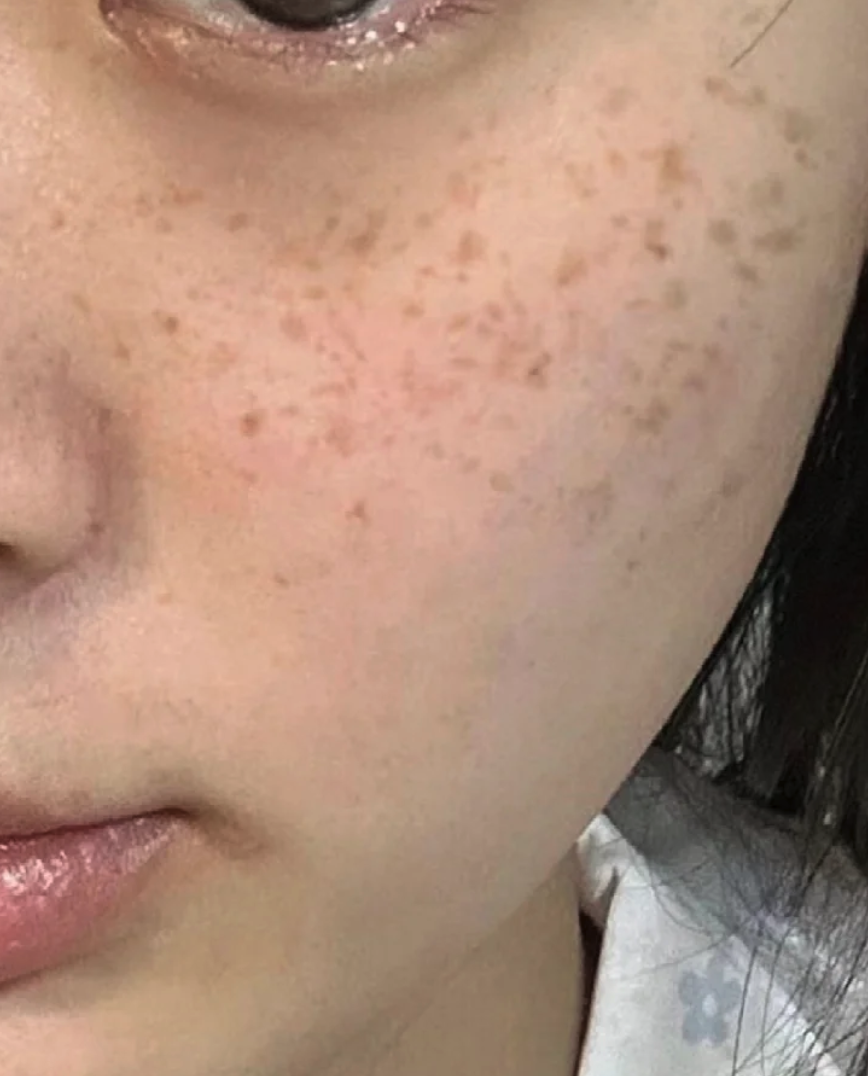 女人长斑是什么原因引起的?