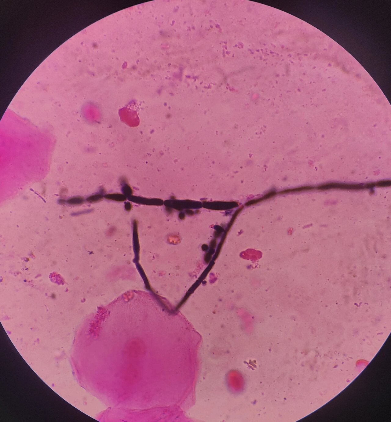 真假菌丝之区别: 真菌丝壁两边平行,不交叉,而假菌丝则反之;真菌丝