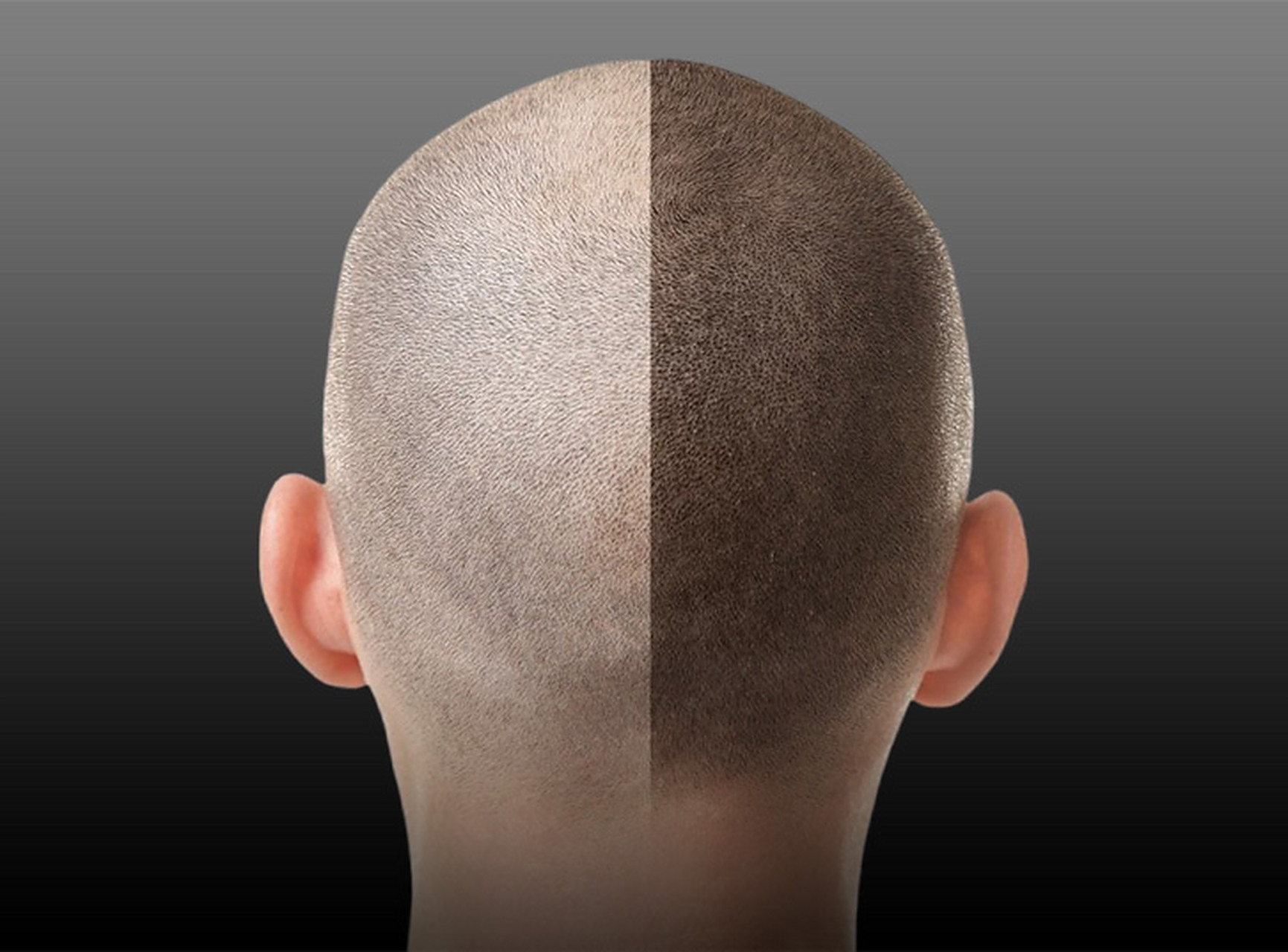 3d纹发能保持几年  3d纹发,一种更先进的头皮微色素沉着(scalp micro