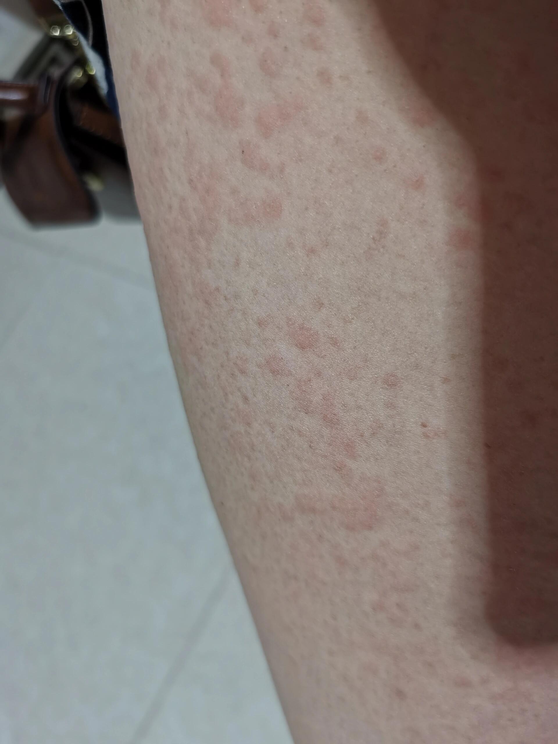 一波未平一波又起,下午突然两个腿过敏