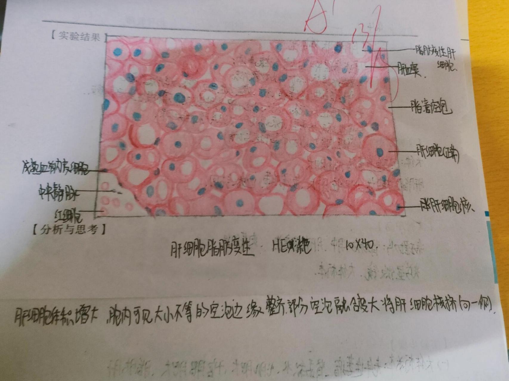 肝细胞脂肪变性 红蓝铅笔