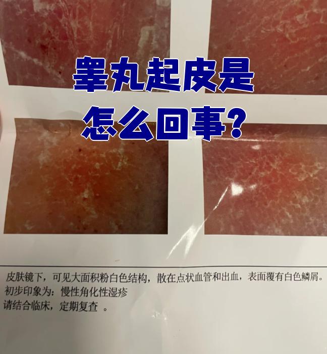 睾丸起皮最常见的原因是慢性湿疹,真菌感染或维生素缺乏