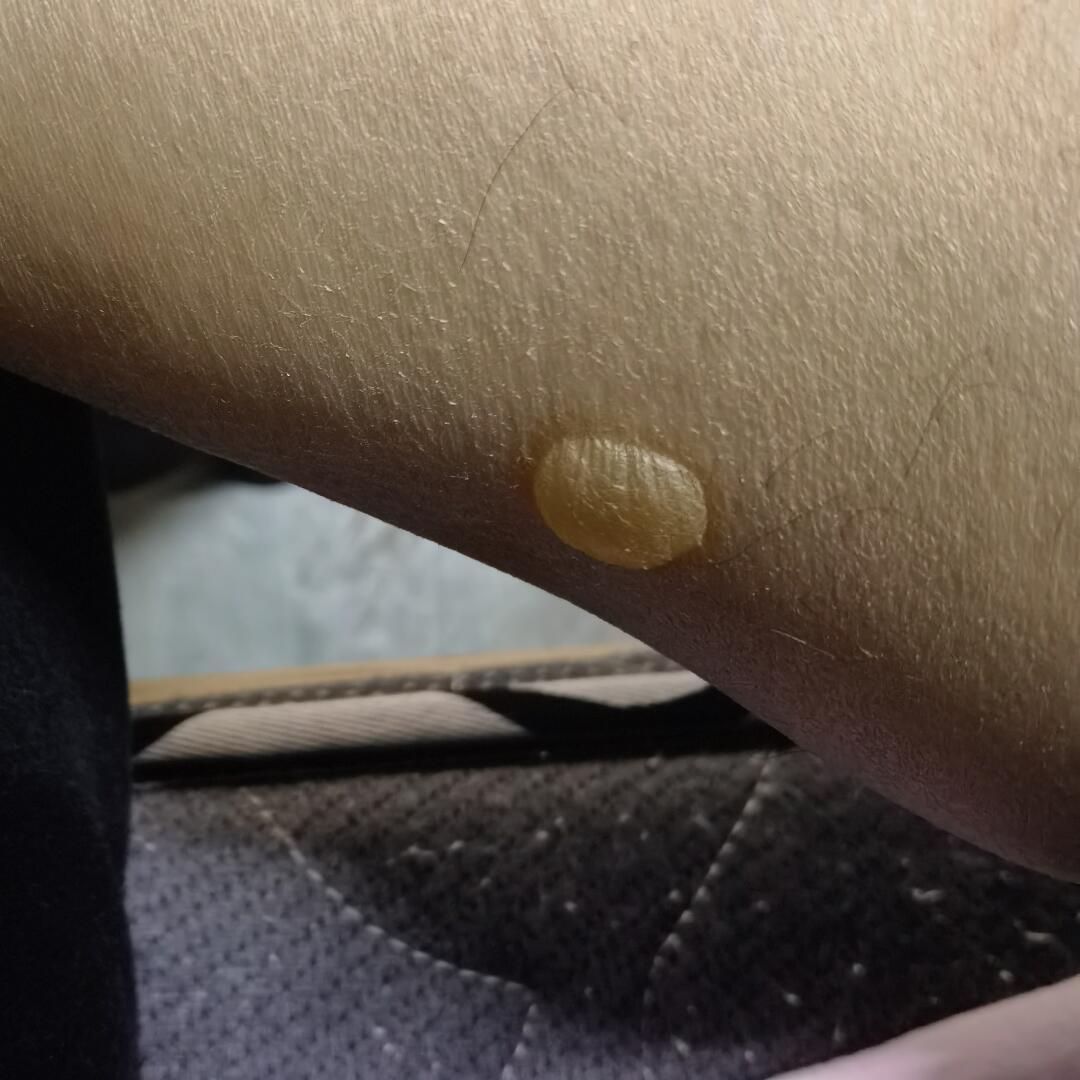 烫伤为什么起水泡