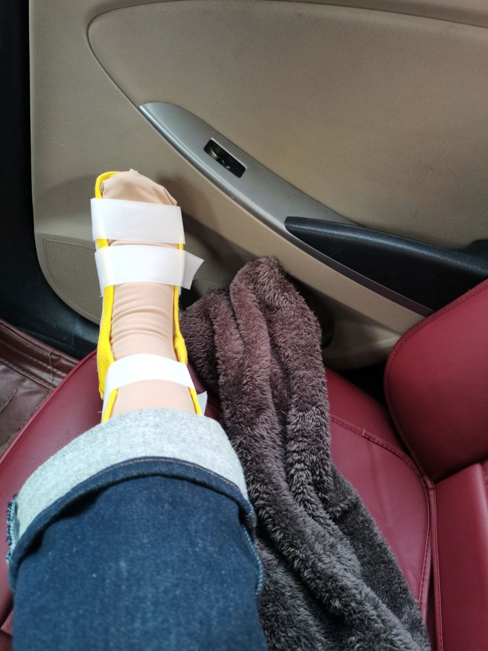 足舟骨骨折的第17天