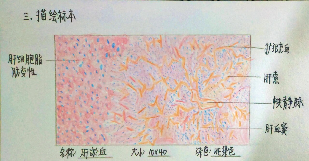 病理红蓝绘图鼻息肉图片