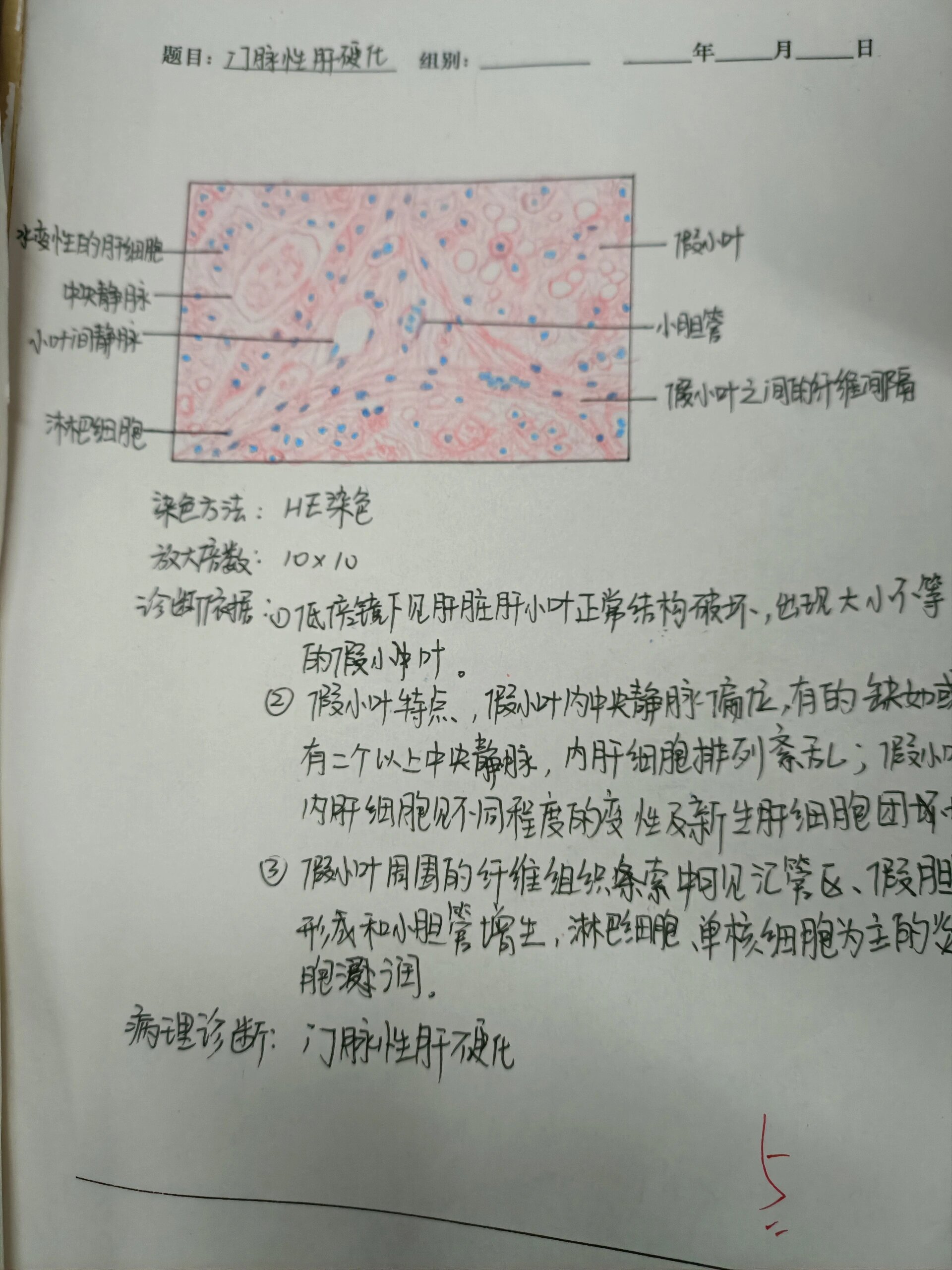 门脉性肝硬化10×10图片