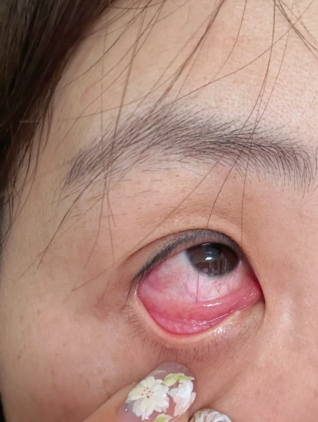 眼睛里长虫子听起来吓人,但确实会发生