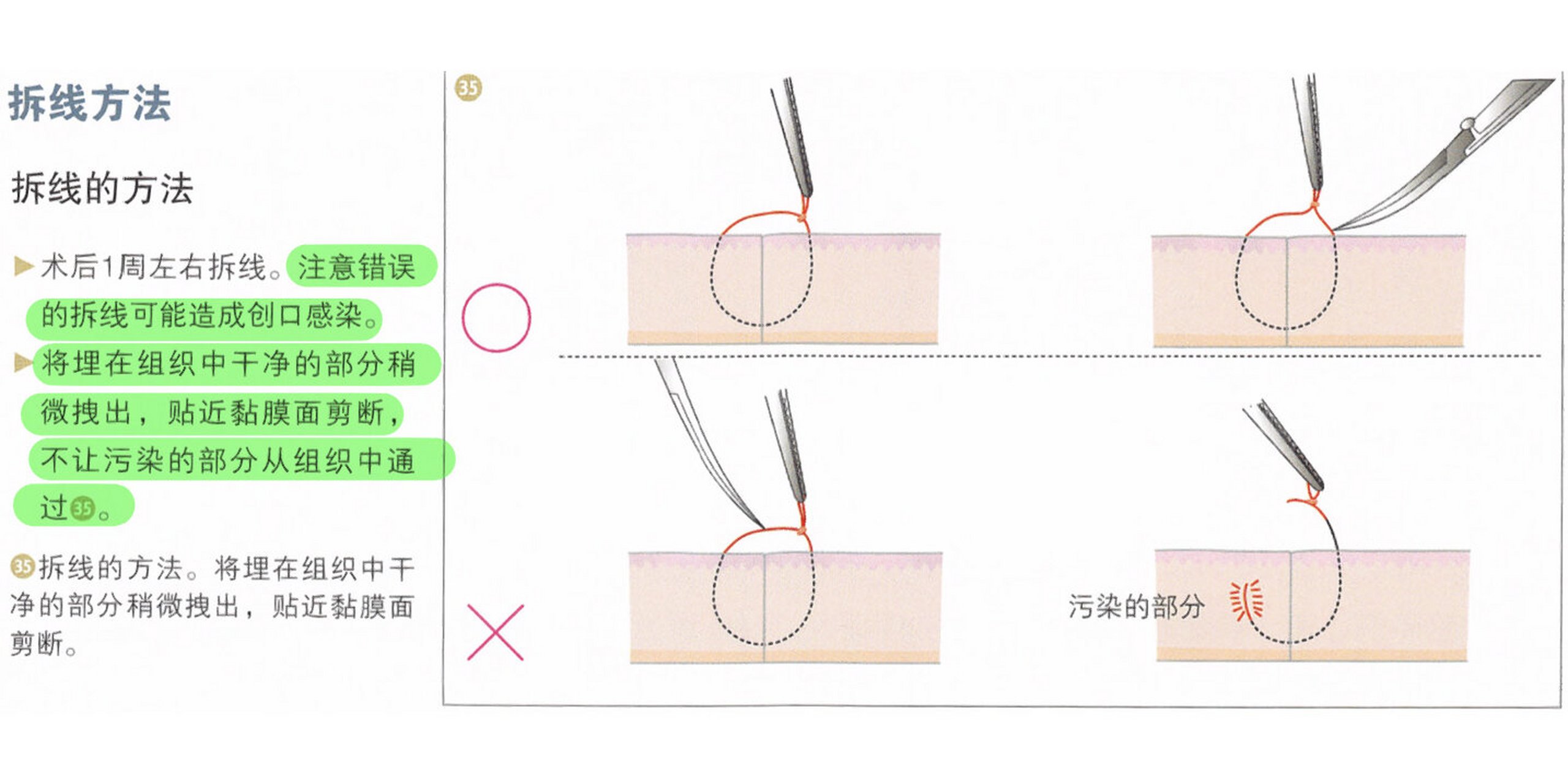 手术拆线图解图片