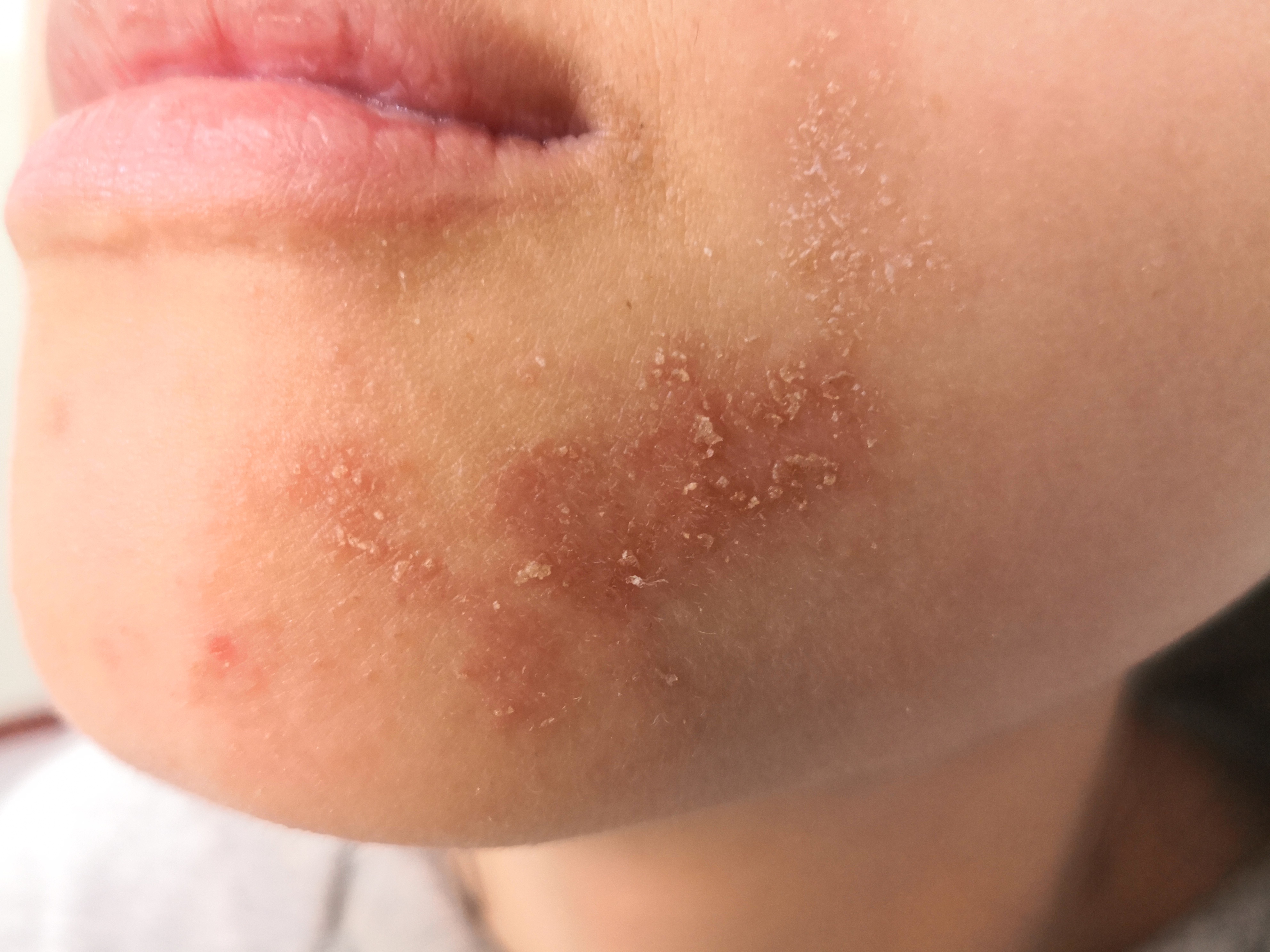 下颌部位的红斑脱屑症.@纪秀军皮肤科主任医师的动态