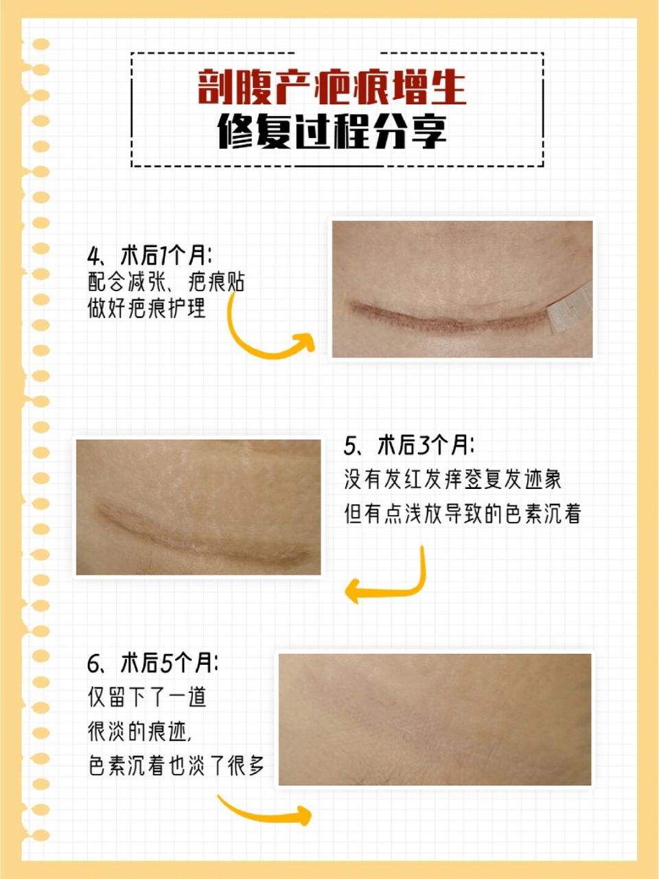 今天就给大家分享一个939969♂15剖腹产疤痕增生手术切除后