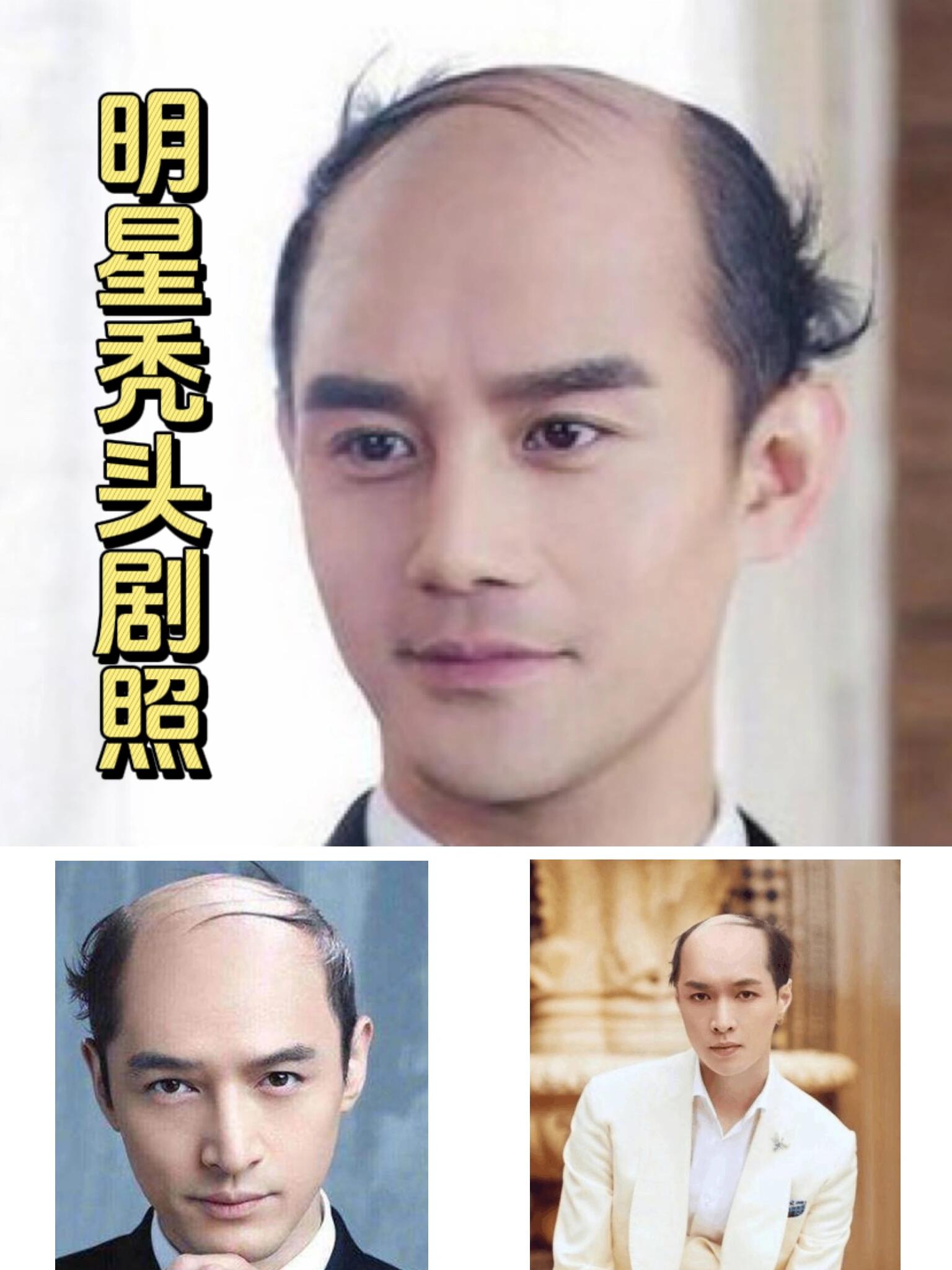 明星不做植发(明星怎么不去植发)