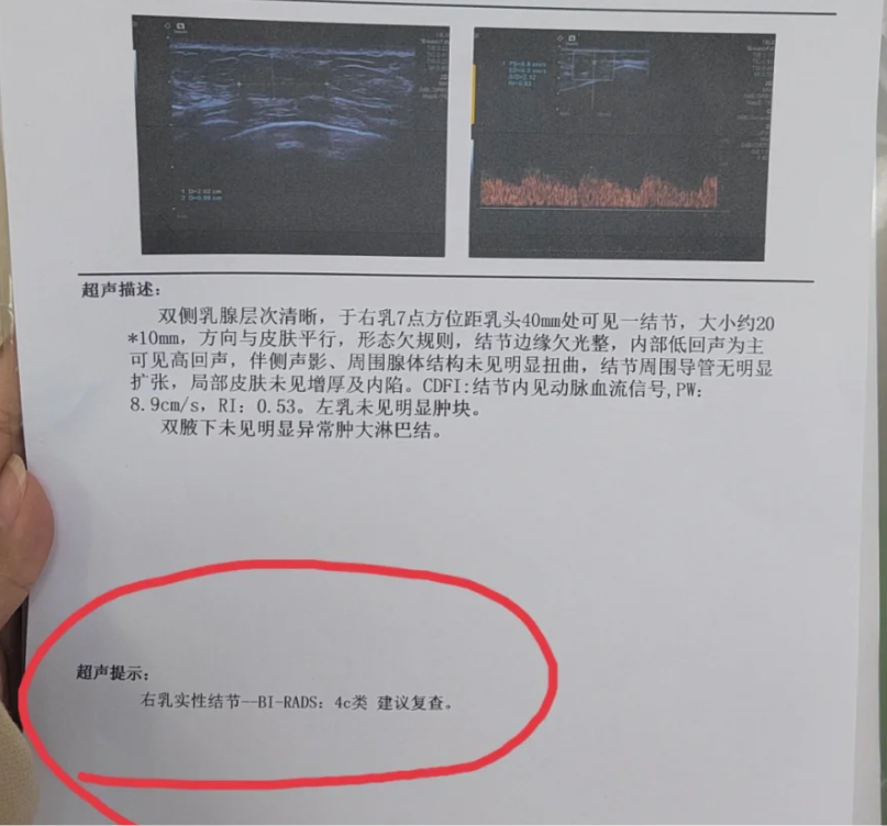乳腺结节的分级中,4a类恶变可能性较低,4b类是中等可能性,而4c类
