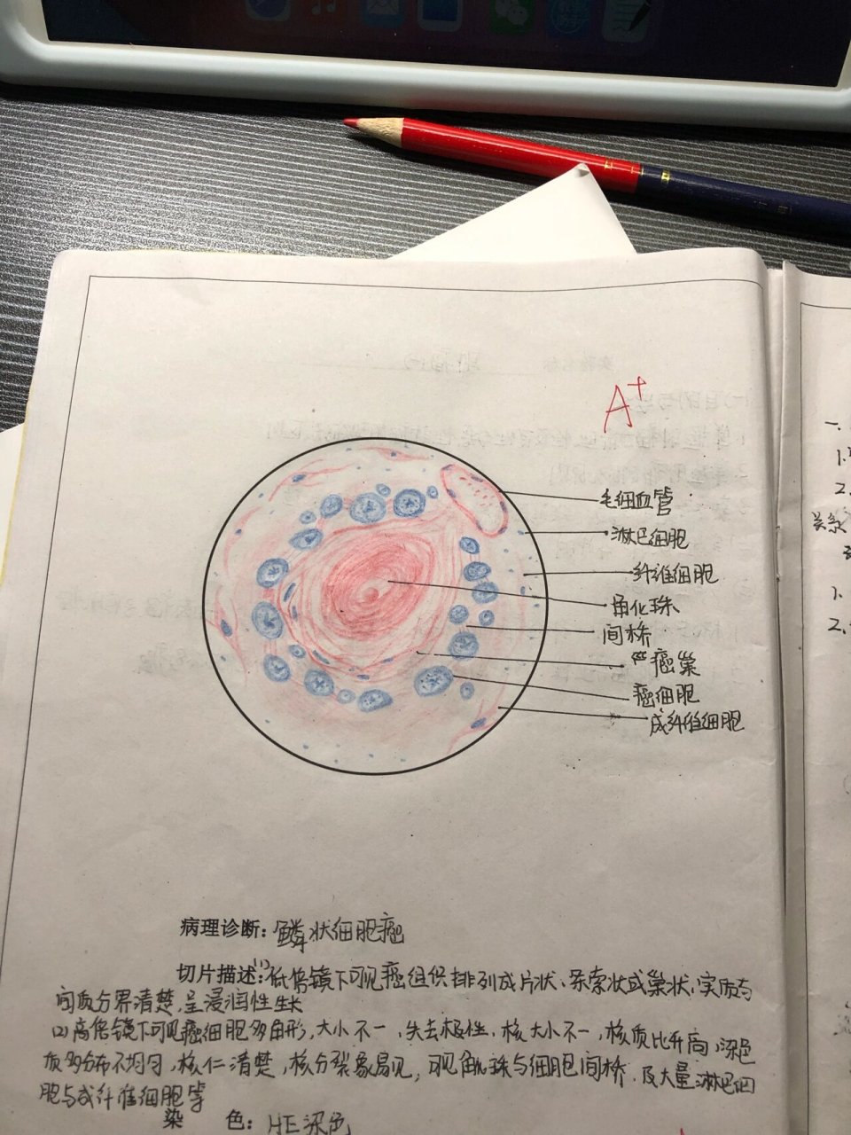 病理红蓝铅笔绘图(三) 鳞癌