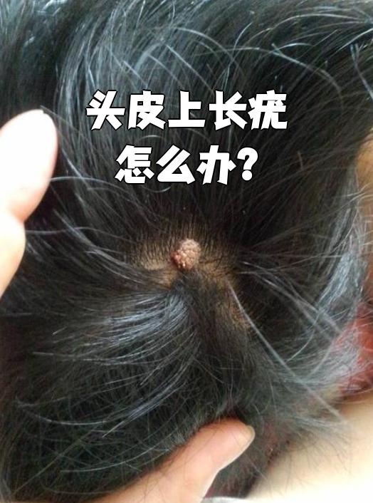 头皮上长疣通常可以用药物涂抹,手术,物理治疗或打针来治疗