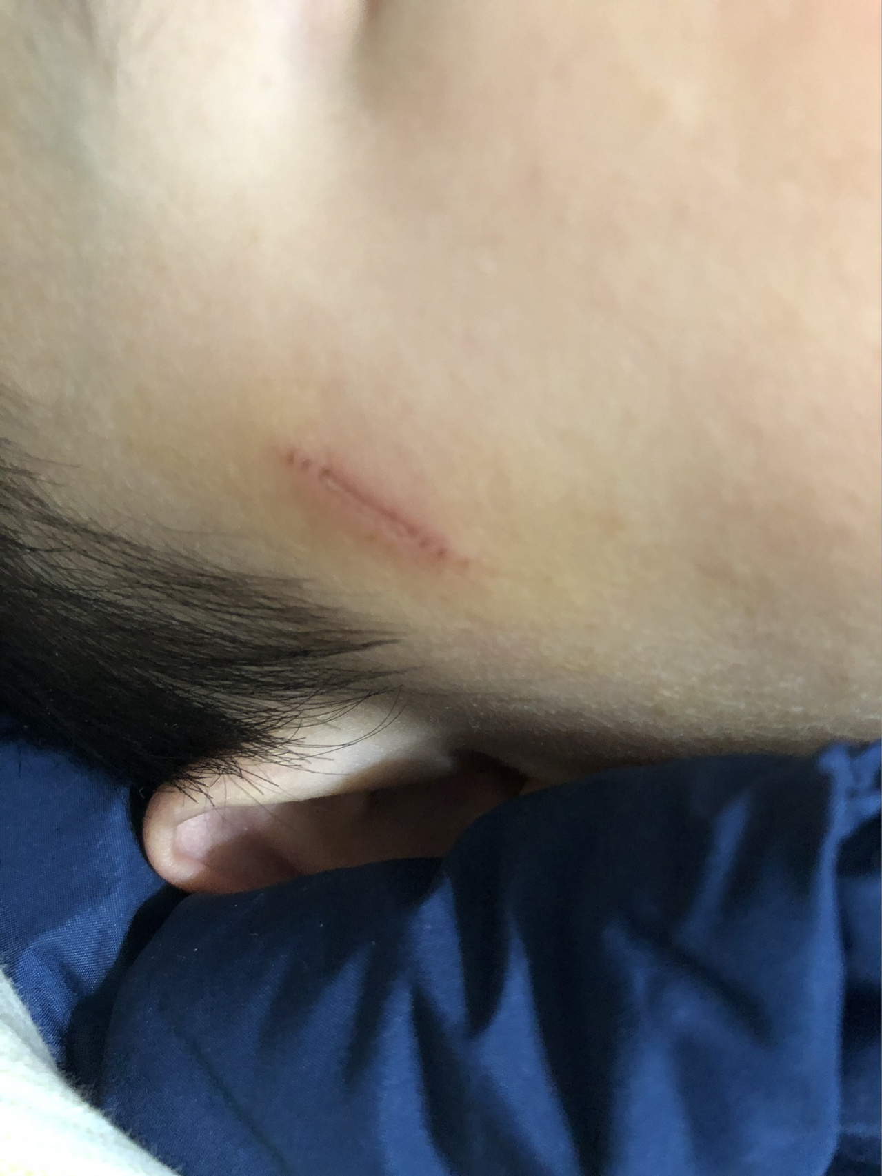 指甲抓伤,会留疤痕吗? 2021年1.