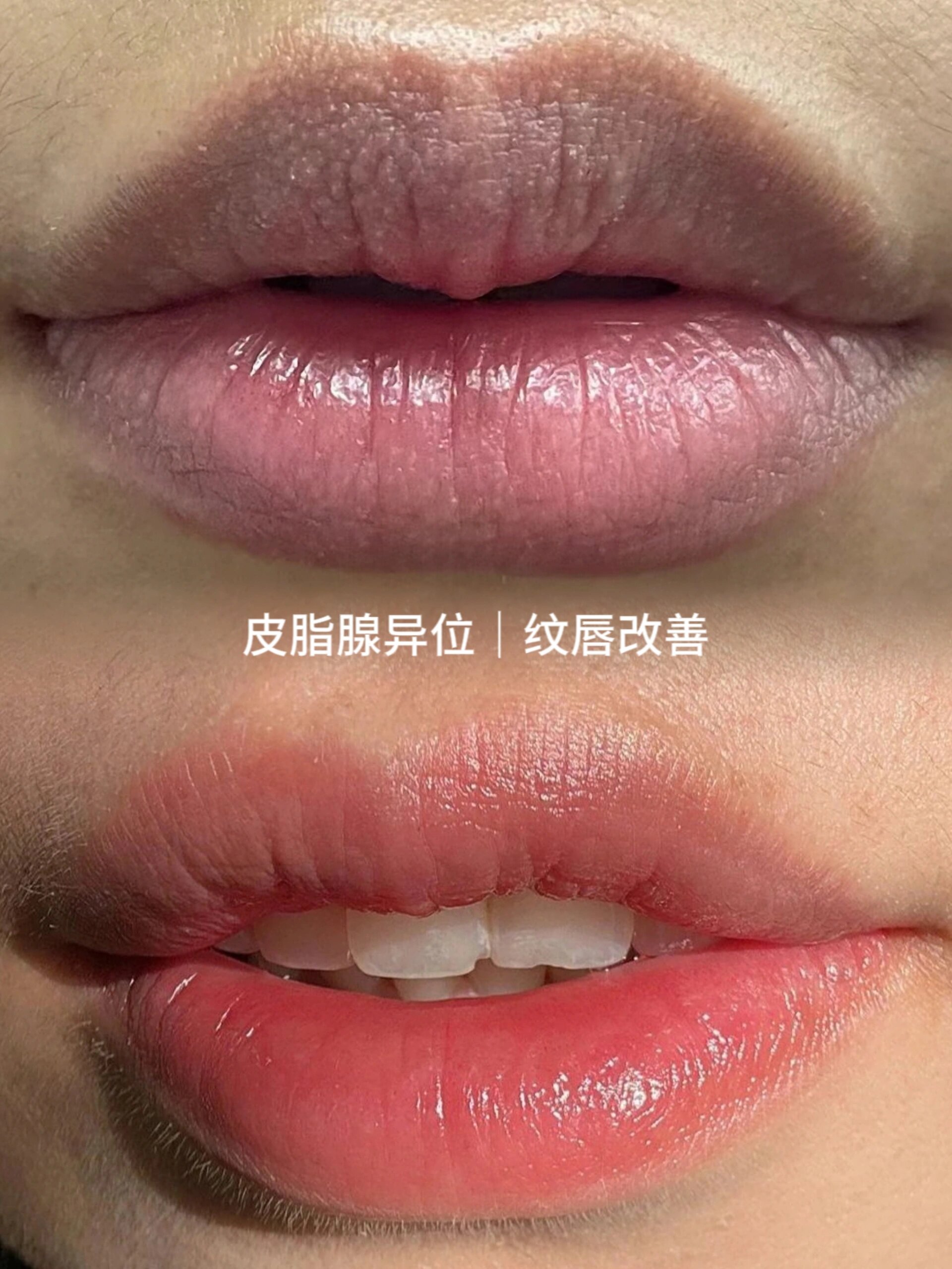 异位皮脂腺图片