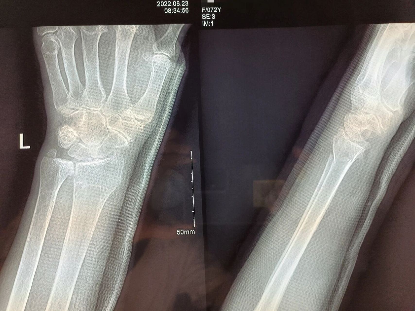 左桡骨远端骨折 患者女,72,左桡骨远端骨折,手法牵引复位高分子夹板外