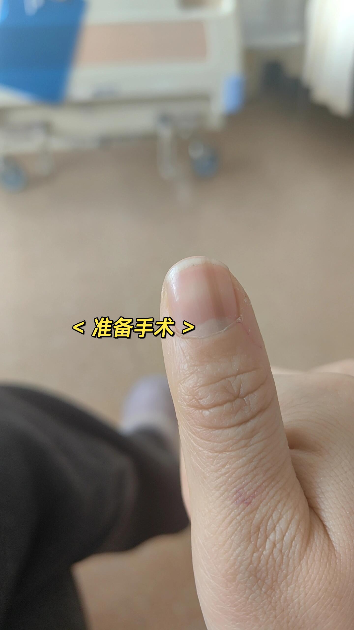 甲母痣手术 终究还是安排上了 第十天不疼了 还是有点肿