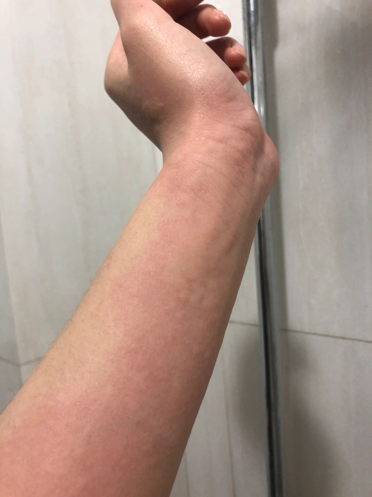 吃小龙虾过敏了 谁懂啊,之前吃的少没有过敏过,结果,今天一次性吃太多