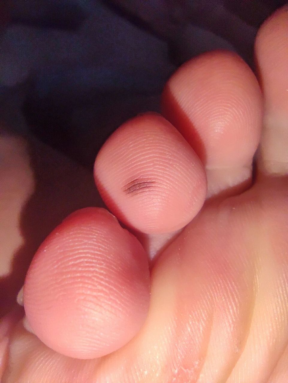 切除了脚趾上的色素痣 02孕期心血来潮去皮肤科问脚趾上的黑痣要不