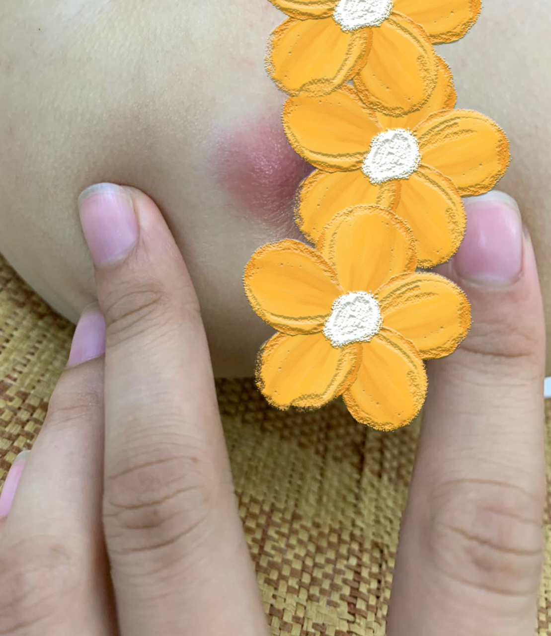 分享一个宝宝肛瘘的草药土方 我们家小朋友七个多月的时候肛门旁边