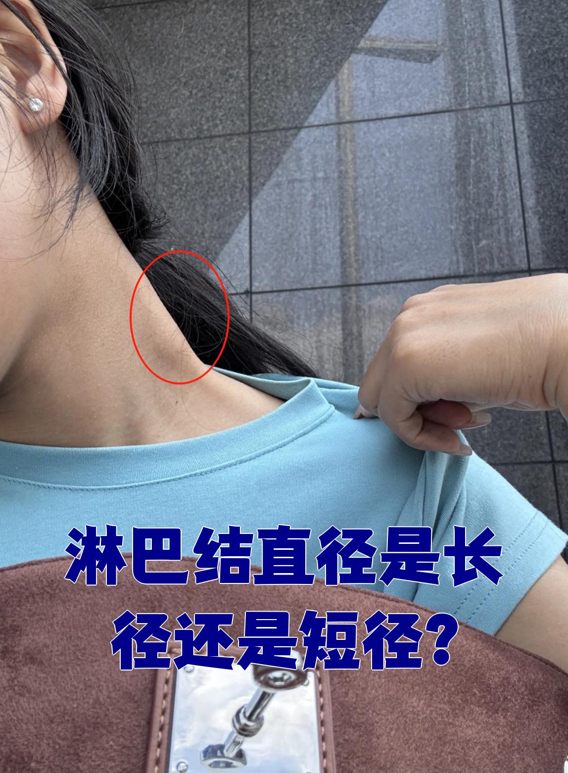 淋巴结直径一般指的是短径