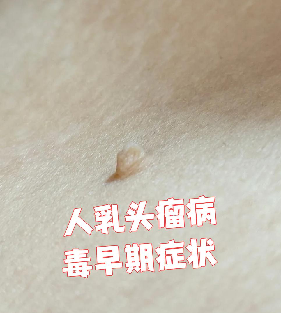 人乳头瘤病毒