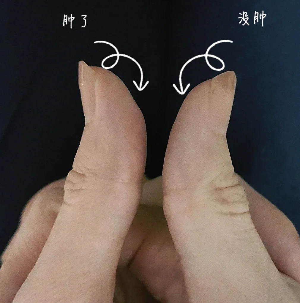 大拇指肿了 莫名其妙,没做什么,突然左手的大拇指就肿了.