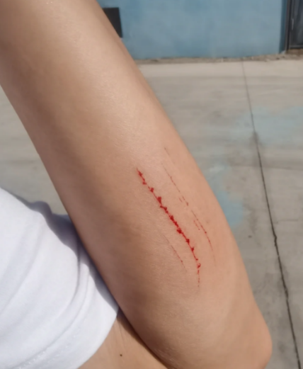 胳膊摔伤后外面看起来没事但里面疼,可能是软组织损伤,轻微骨挫伤或