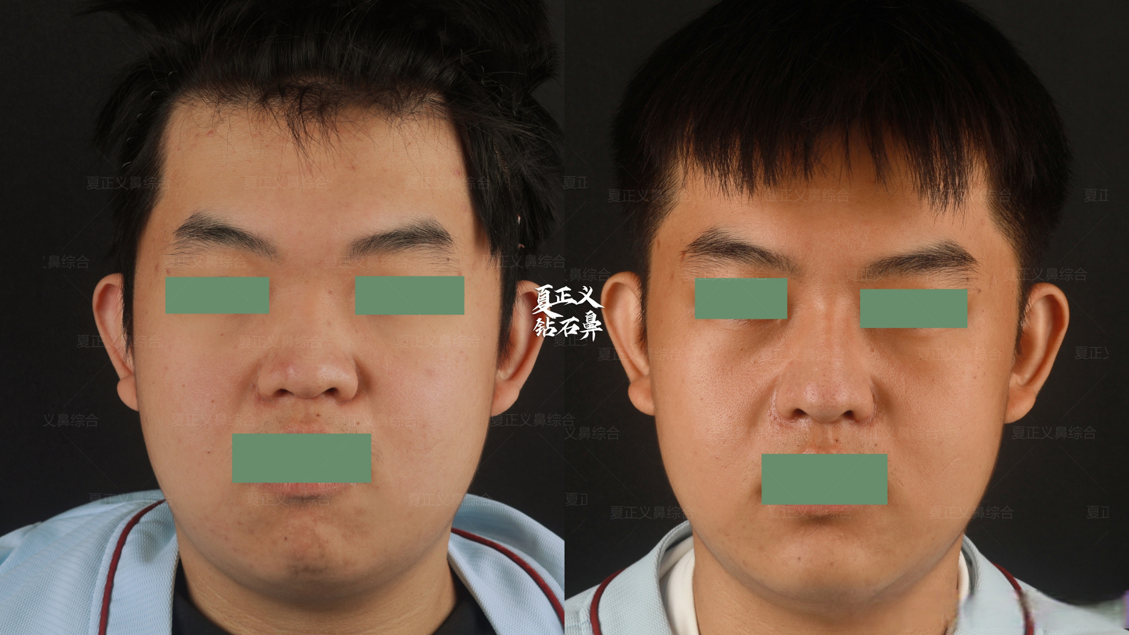 鼻,山根无转折,鼻梁低,鼻翼宽,鼻基底凹陷,改善重点在于延长鼻子长度