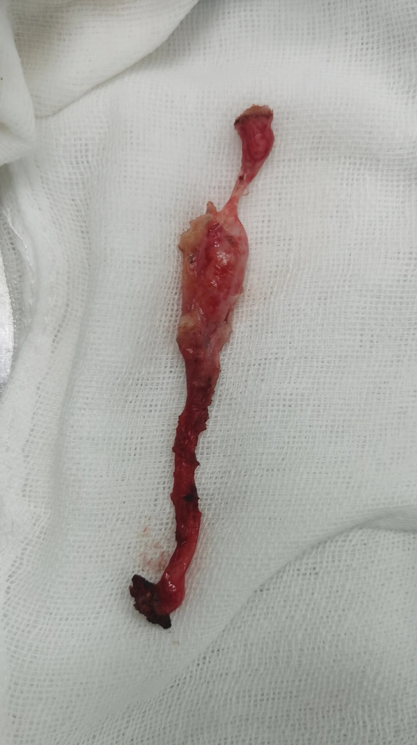 啥是脐尿管囊肿?