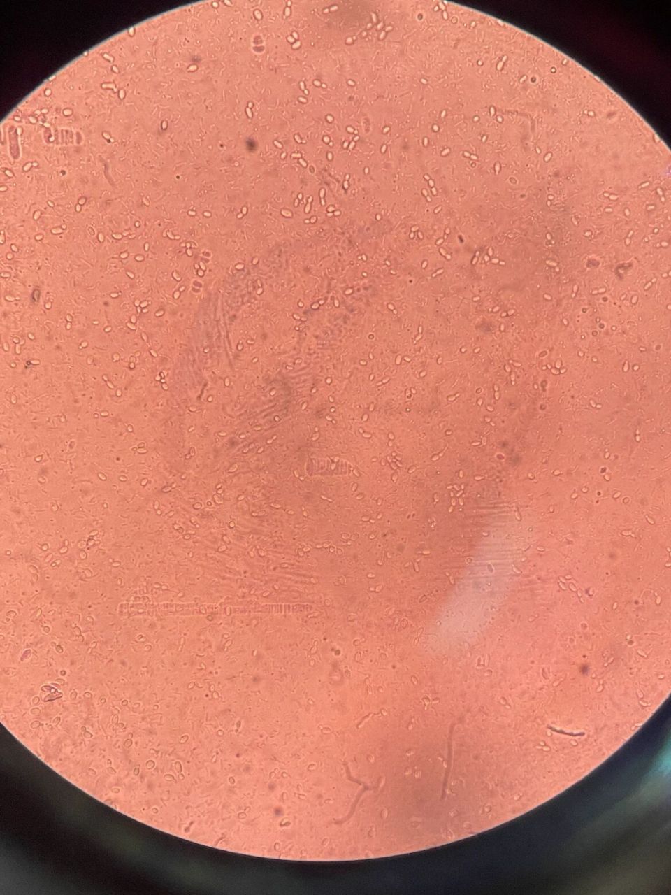 霉菌孢子显微镜94图 霉菌性阴道炎是我国妇科门诊最常见的阴道炎症