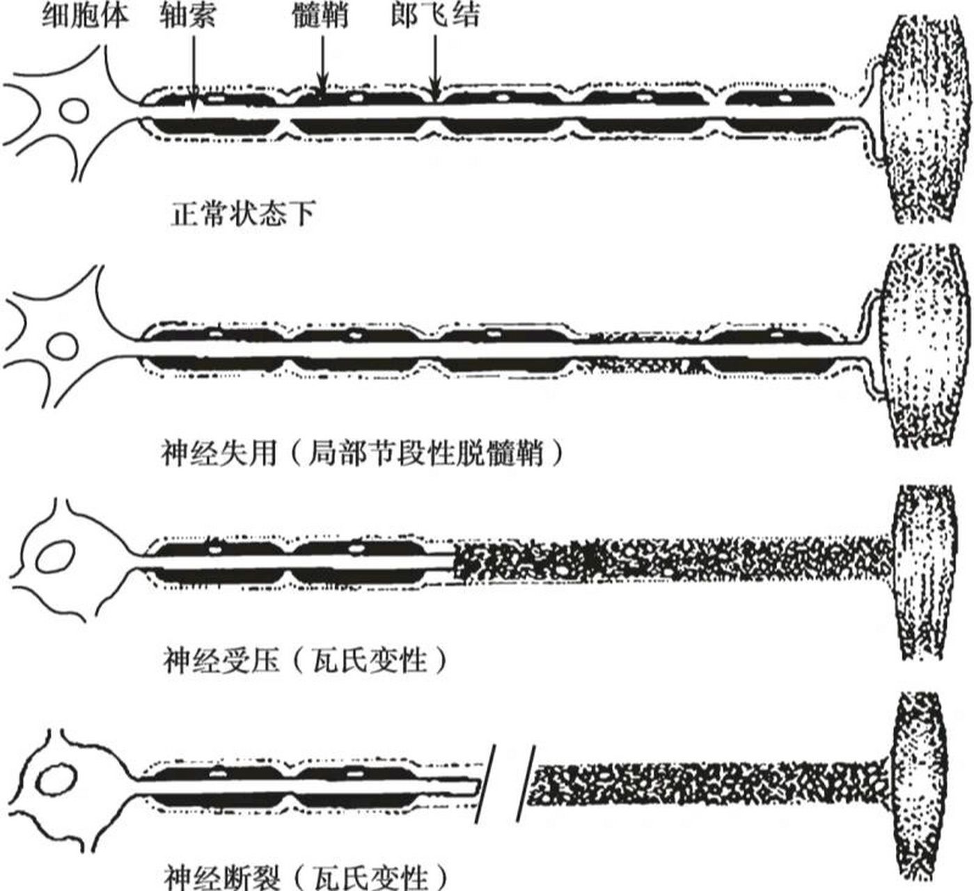 一, 神经传导(nerveconduction study,ncs)肌电图: (检查外周神经