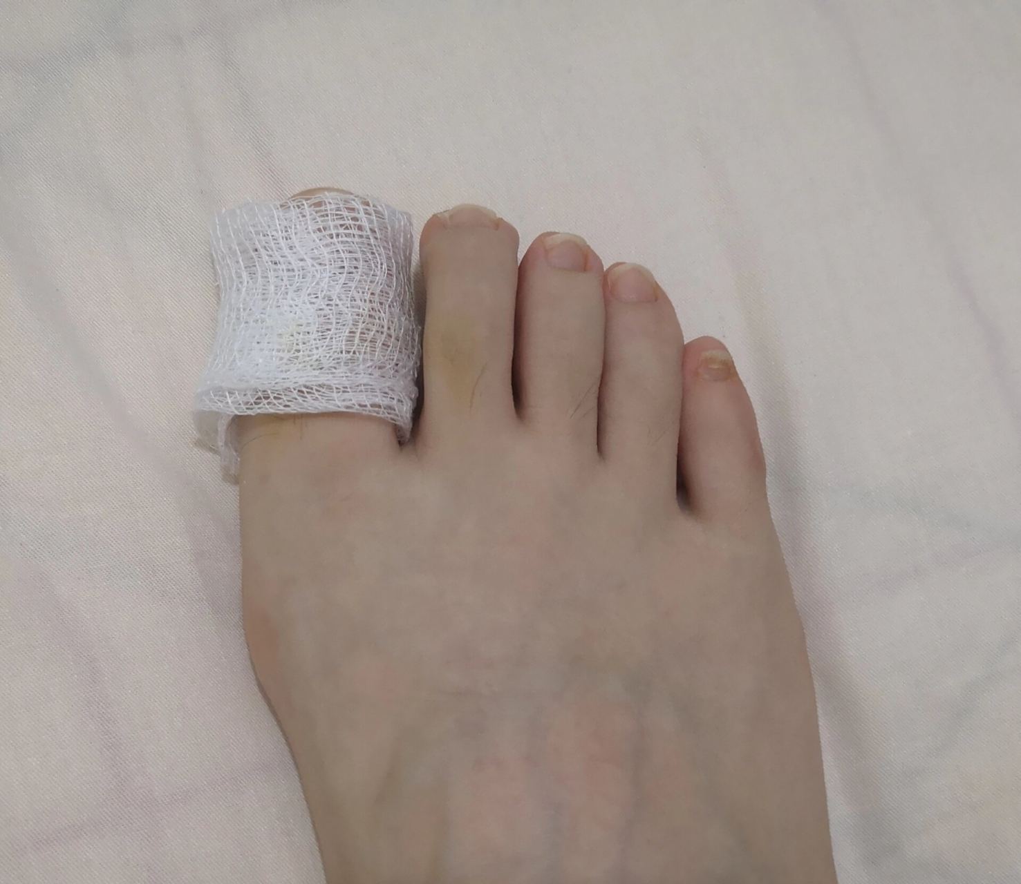 脚大拇指肿还化脓了怎么处理? 1,温水洗净双脚,用碘伏消毒红肿部位.